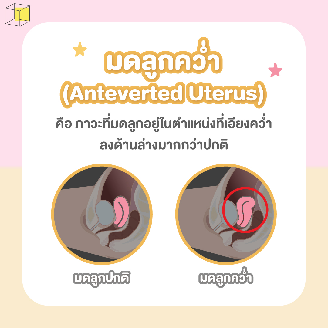 มดลูกคว่ำ คือ