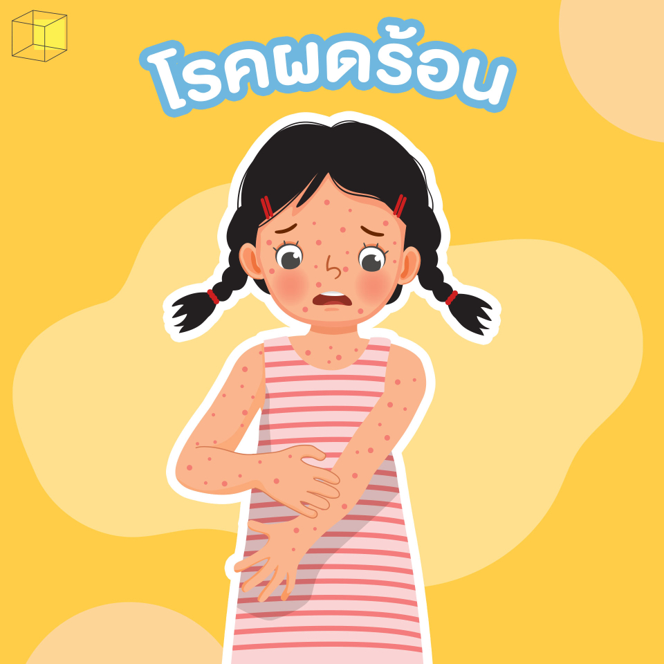 โรคหน้าร้อนในเด็ก-โรคผดร้อน