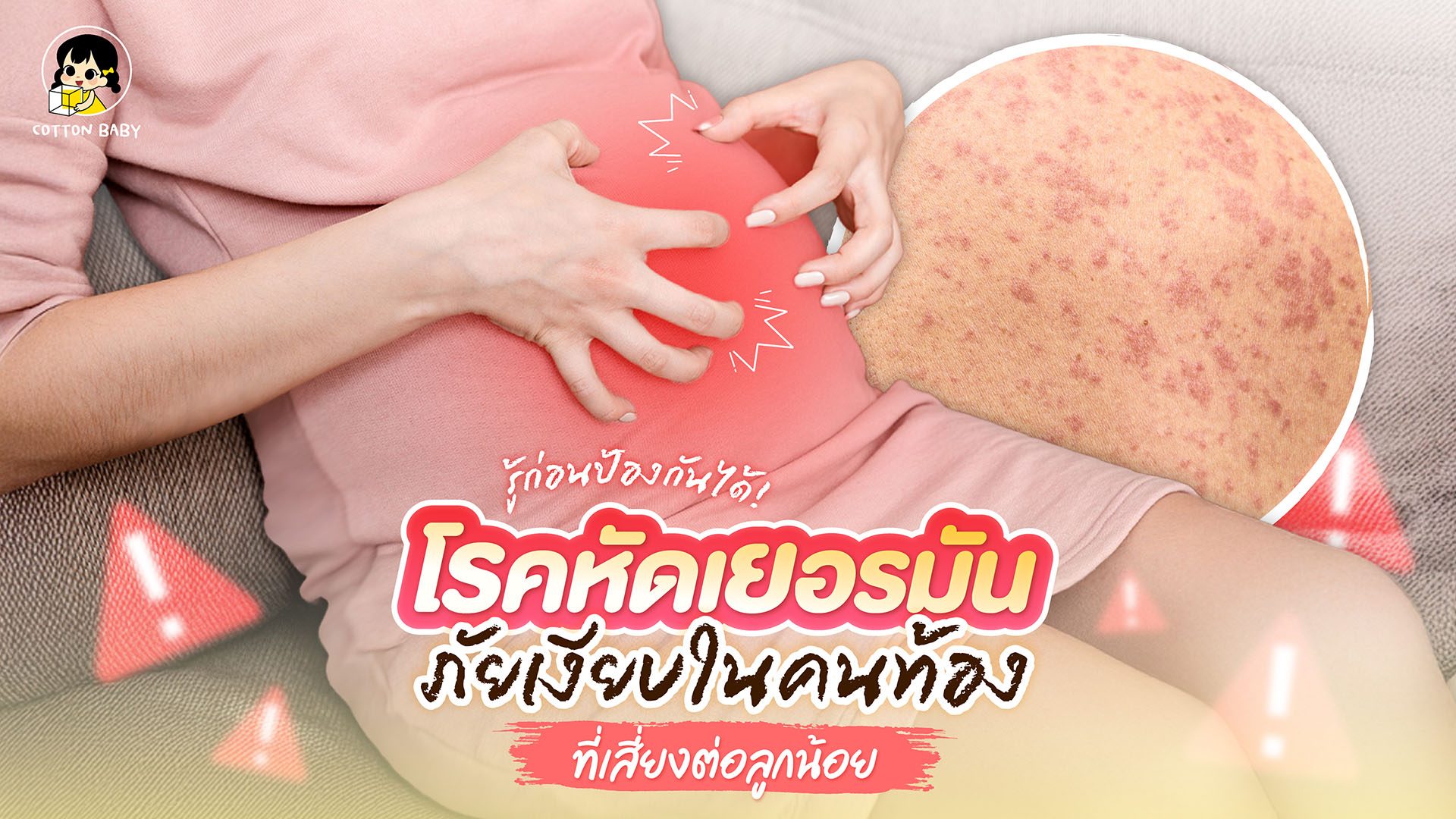 โรคหัดเยอรมันในคนท้อง